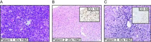 a-c)Liver biopsy results for three individuals with acute hepatitis (and SJIA)