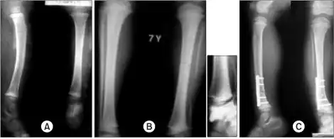 a)Radiographs show a large segmental fibular defect by chronic osteomyelitis b,c) four years later, serial radiographs show a valgus deformity of ankle due to upward migration of distal fibula