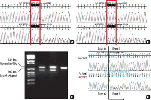 Heterozygous mutations in the KCNQ1 gene- a) Genomic DNA sequencing indicates c.828_830delCTC, p.S277del, heterozygote b) c.921G>A, p.V307V, heterozygote c) PCR detects abnormally spliced mRNA product, exon 6 had been skipped d)PCR products confirms exon 6 skipping due to mutation