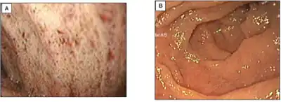 a)Endoscopy shows white duodenal mucosa (affected subject) b) normal subject