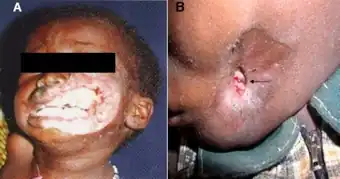 a. Rapidly destructive and fulminatingdisease requiring lengthy antibiotic treatment prior to surgery. b. Arrested advanced disease requiring short course of antibioticsbefore surgical reconstruction (arrow indicates sequestrumformation)