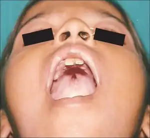 Hutchinson's teeth (and palatal perforation )