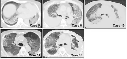 Chest CT images of five persons/cases who developed acute interstitial pneumonia