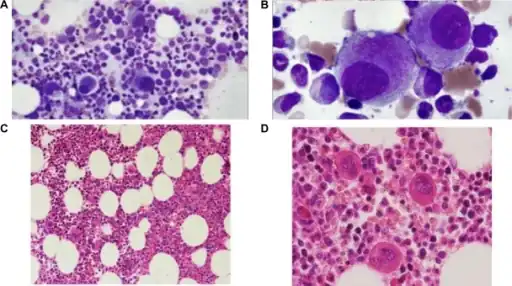 Myelodysplastic syndrome (with isolated del (5q)) a,b) Hypolobated megakaryocyte c,d)hypercellular bone marrow with myeloid proliferation associated with hypolobated
