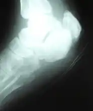 Xray of right heel at end of treatment
