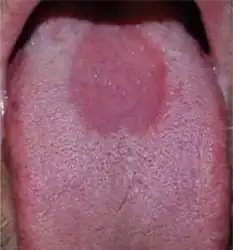 Median rhomboid glossitis (in a diabetic)