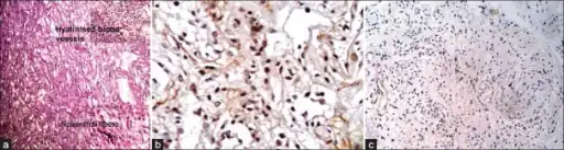 a-c) Photomicrograph shows microcystic areas in pilocytic astrocytoma