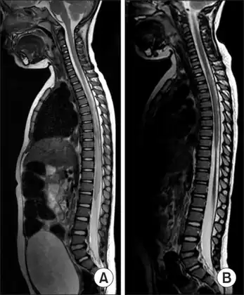 MRI of individual diagnosed with transverse myelitis