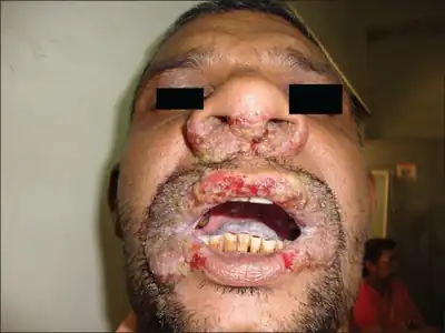 Pemphigus with crusts