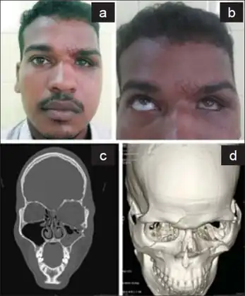 a) Sunken and inferior displaced eye on left b) restricted left eye movement in upward gaze c) blow out fracture of left orbital floor d) fracture and outward displaced left orbital floor