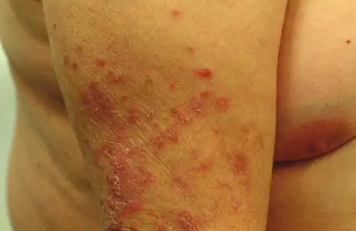 Drug-induced subacute lupus erythematosus: Red and scaly plaque on a left back of arm