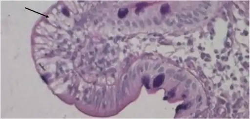 Duodenal biopsy from ABL individual shows vacuolated enterocytes