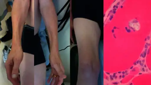 Bilateral medial forearm and quadriceps wasting of inclusion body myositis (rimmed vacuole within a muscle fibre histopathologically