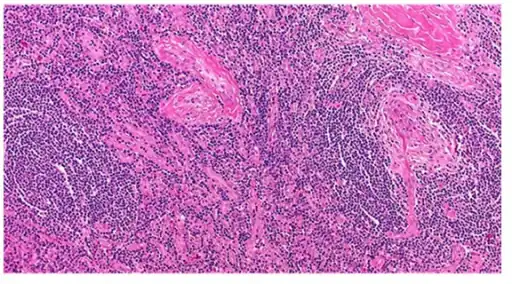 Appearance of hyaline vascular type Castleman's disease (histology)
