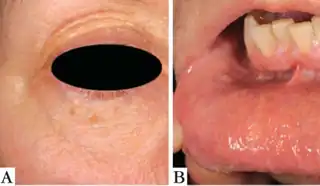 Cowden syndrome- a) yellowish papules around eye b) papular lesions on the lips