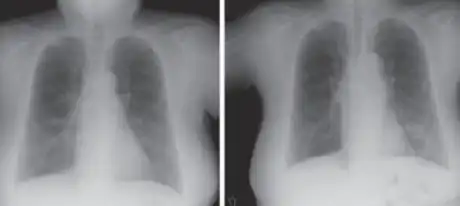 a,b)Hollow lesion in the lower left lung field was diagnosed as a lung abscess