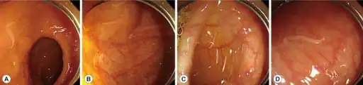 a-d)Via a colonoscopy numerous amount of Hymenolepis nana adult worms were found scattered throughout a colon