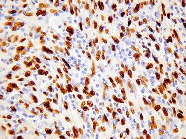 EBER in situ hybridisation showing Epstein–Barr virus encoded RNA