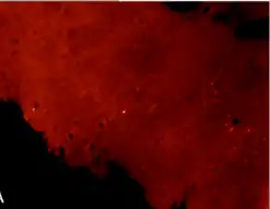 Nuclear expression of the p53 protein in oropharyngeal cancer, HPV-positive cancer sample exhibiting absence of p53 immunofluorescence[51]