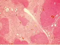 Histology of congenital hepatic fibrosis