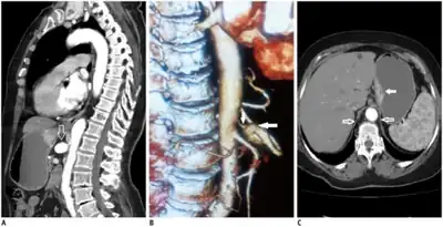 Median arcuate ligament syndrome-a)Stenosis and aneurysm of celiac artery because of compression arrows b)severe stenosis and poststenotic dilatation white arrow c) median arcuate ligaments arrows and gastric mucasal thickening