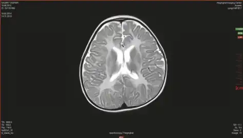 Canavan’s disease demonstrates bilateral symmetric T2 white matter hyperintensity including involvement of the subcortical arcuate fibers