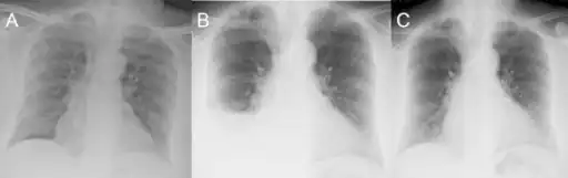Olanzapine-induced eosinophilic pleuritis;a)Prior to olanzapine therapy, b) CXR at presentation, c) CXR 6 months after olanzapine withdrawal.