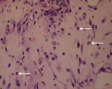 Pleural biopsy demonstrates a chronic inflammatory cell infiltrate and eosinophils induced via olanzapine