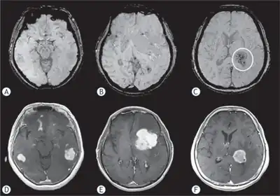 Primary central nervous system lymphoma a) Grade 1: multifocal tumors show no intratumoral susceptibility signal b) Grade 2: shows punctate low-intensity signals arrows c) Grade 3: low-intensity signals circle d,e,f) shows primary central nervous system lymphomas with intense enhancement