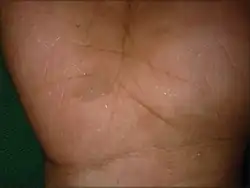 Brown colored macule of tinea nigra