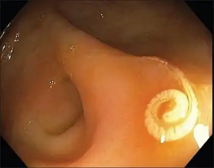 Endoscopic view of Trichuris trichiura in cecum
