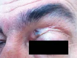 Solitary, smooth surfaced, hyperpigmented 1 cm nodule is located on left upper eyelid