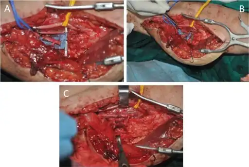 Flow-through anastomosis of the T-shaped pedicle. A) The diameter of the profunda femoris segment is obviously larger than that of the nutrient artery of the gracilis. B) The brachial artery was resected, and the diameters of the segment profunda femoris and brachial artery were well matched. C) Interposed anastomosis to bridge the brachial artery. Two veins were anastomosed in direct end-to-end fashion.