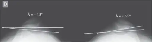 Negative lateral inclination angle (Â) of patella in right knee with ACL injury and positive angle in normal left knee.