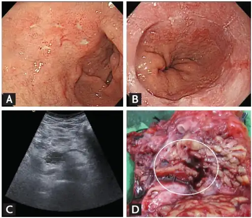 Hyperacidity of stomach due to Zollinger-Ellison syndrome-a)Duodenal ulcers poorly healed b)reflux erosive esophagitis c)pancreatic tumor d)confirmed as neuroendocrine tumor