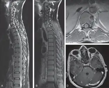 Myeloradiculopathy in tuberculous meningitis[16]-a) Long segment myelitis b,c) intramedullary tuberculoma at D10 level d)multiple tuberculoma involving cerebrum, cerebellum, and brainstem