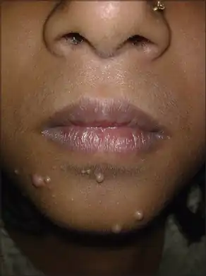 Molluscum contagiosum in young individual