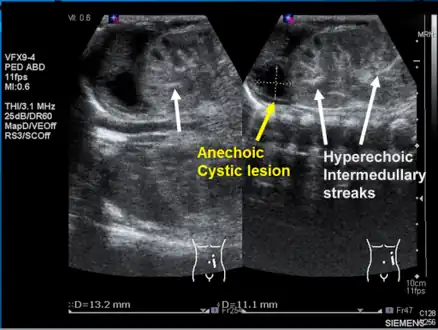 Left kidney with a suprarenal anechoic cyst-like lesion and hyperechoic intermedullary streaks in initial phase of renal vein thrombosis