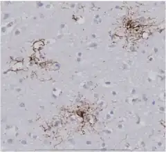 Tufted astrocytes in the frontal cortex