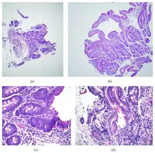 a,b)Moderate/severe shortening of most villi c)focal superficial epithelial d) crypt architectural changes.