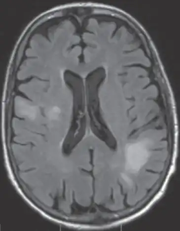 High signal intensity lesion of white matter of dorsal right frontal lobe/right frontal operculum