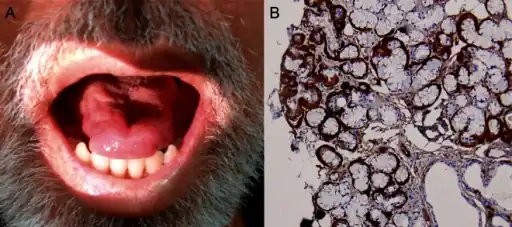 a)Tongue atrophy due to transthyretin-related familial amyloid polyneuropathy(synonym [16]) b)minor salivary gland biopsy