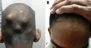 Nodules under the skin of the scalp