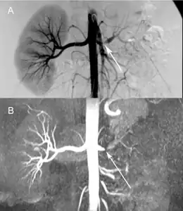 Comparison a) Digital subtraction arteriography and b) Unenhanced Magnetic resonance angiography of suboclusive left renal artery stenosis arrows