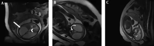 Aqueductal stenosis in a fetus a) Axial b) coronal c) sagittal
