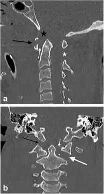 a,b)Jefferson’s fracture in a male victim of a motor vehicle accident