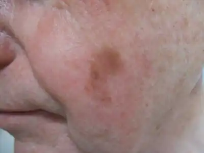 Lentigo maligna melanoma on cheek