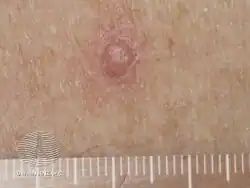 Papilloma due to vemurafenib