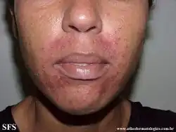 Periroal dermatitis