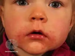 Perioral dermatitis